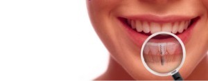 bkpam2127667_implantinvsi-300x117