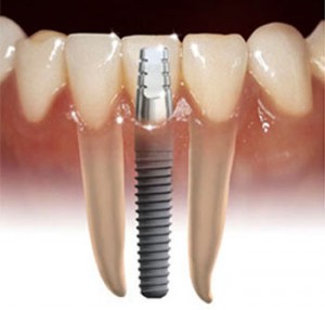 implant_2