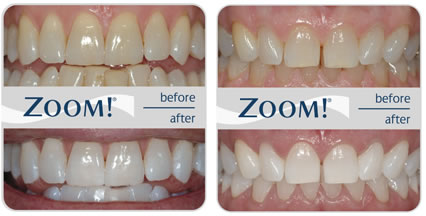 zoom-teeth2