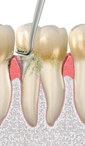 Dental Plaque Tartar