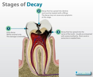 Stages-of-tooth-decay