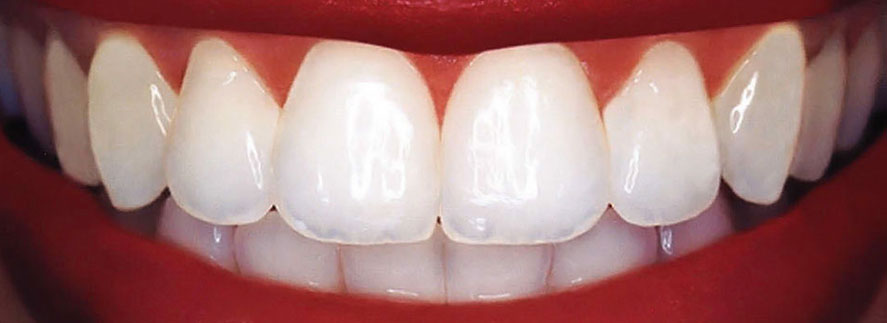 Dental Bonding Perfect Smile