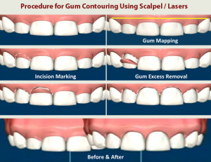 gum_recountouring_procedure