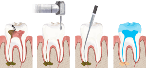 root-canal
