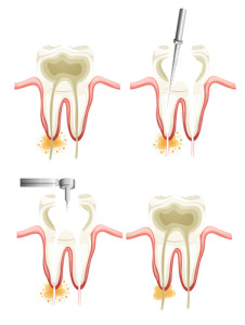 Root canal procedure