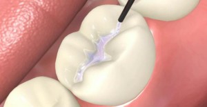 Dental Sealant