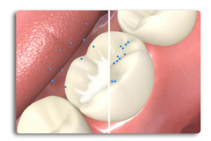 Dental Sealants Benefits