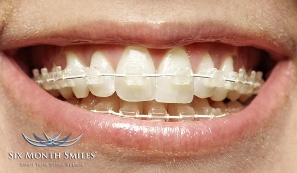 six-month-smiles-2