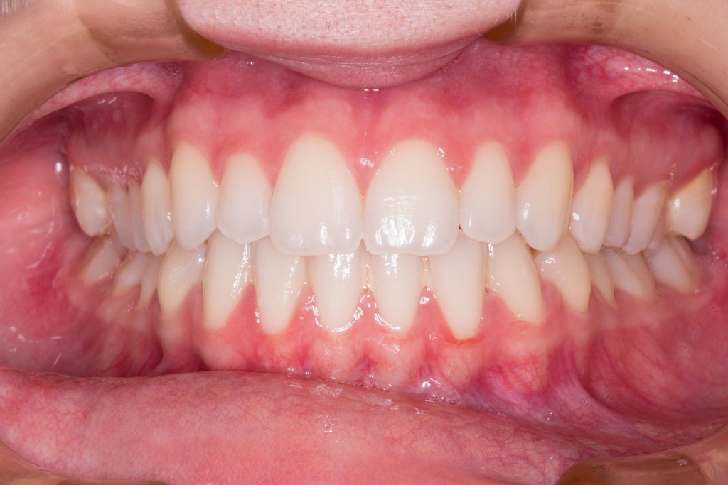 teeth-2339168_1920