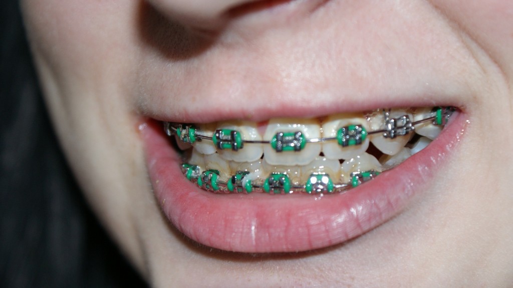 tooth-366335_1920